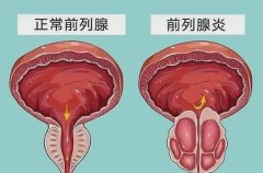 前列腺炎【附图】新乡男科医院哪里看的好？